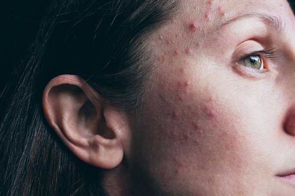 Read more about the article Adult female acne: Why it happens and the emotional toll